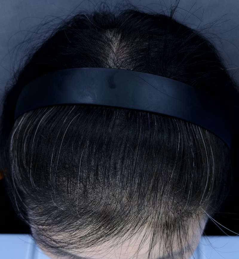 이식,관리,smp 헤어라인 후.png