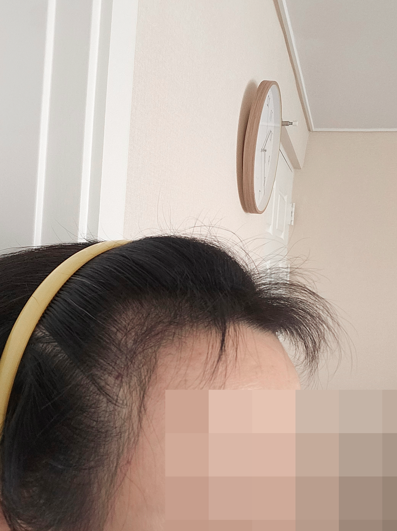 모바름미작에서 헤어라인 비절개 3200모