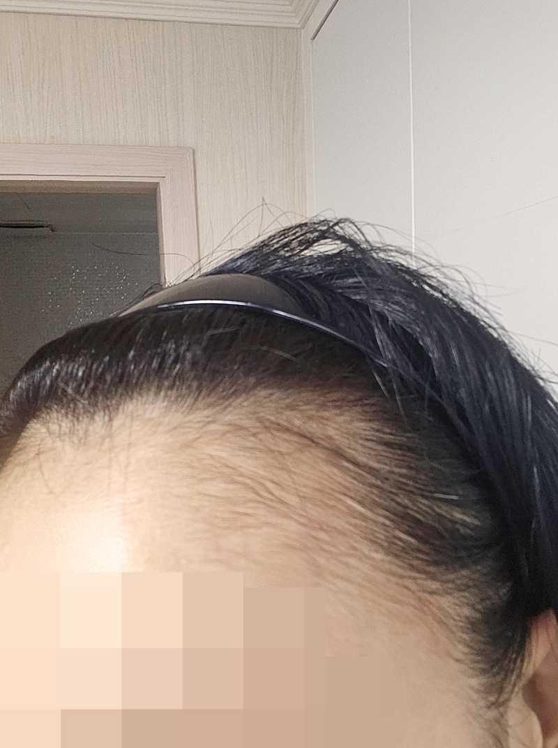 모마름미작의원에서 비절개 모발이식 받고 새 삶 찾은 후기!