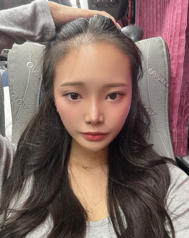 여자 헤어라인 교정 절개 2000모낭 세달차 후기