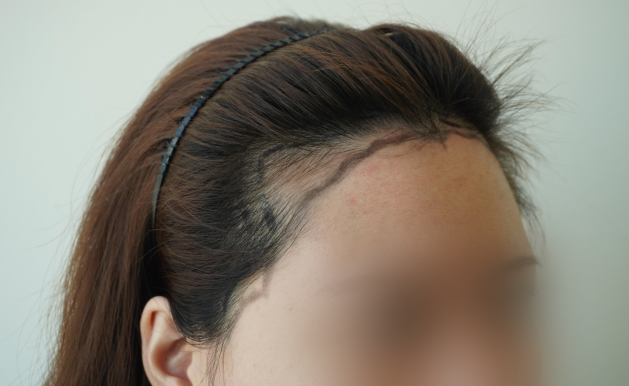 모바름미작 헤어라인 모발이식 내돈내산 만족해요