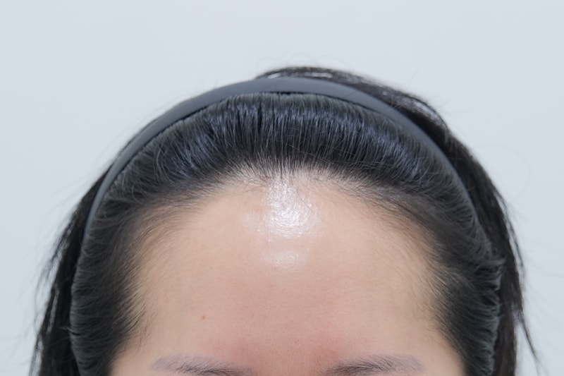 이마가 점점 넓어져서 고민이었는데 연세모에버 모발이식 받고 해결했어요