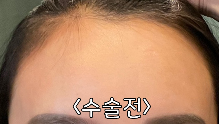2200모낭 엠자 비절개 이식 2개월차 유승현원장님 후기