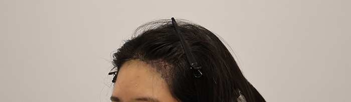 수술직후2.JPG