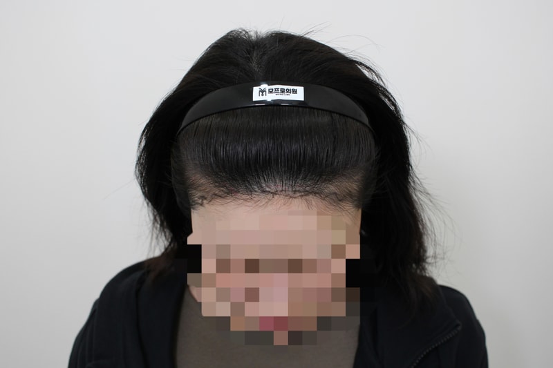 신사동 모프로의원/문건학 원장님/헤어라인 이식2400모 /6개월 후기 작성 