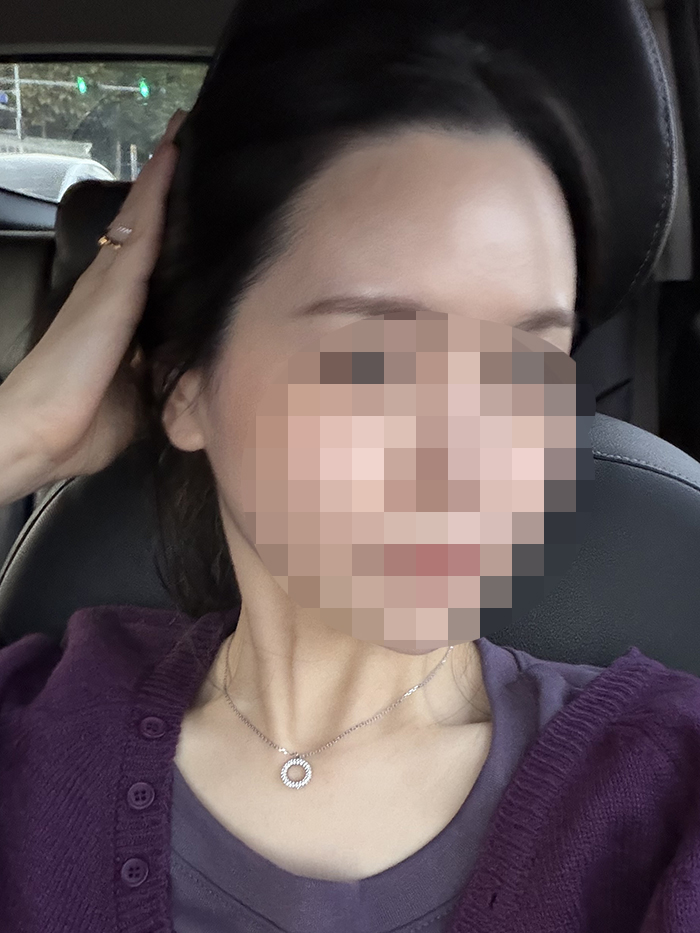 02.수술3년 8개월.jpg