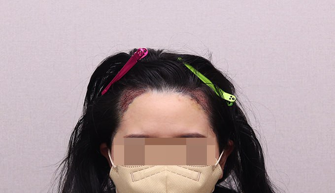 07.수술 끝나고 부은 얼굴이었을 때ㅎ.jpg
