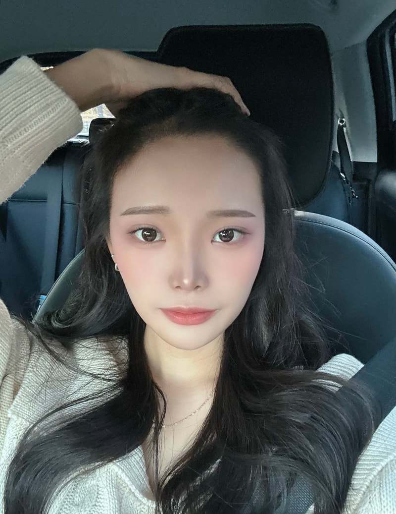 여자 헤어라인 교정 절개 2000모낭 4개월차 후기