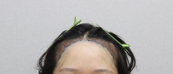 06.수술다음날.JPG