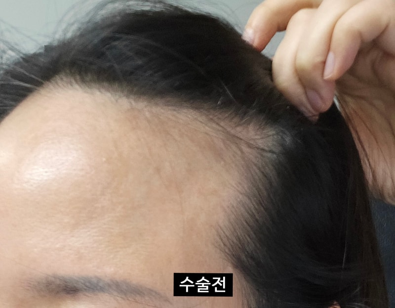 2300모낭 무삭발 비절개 각진이마 채운 후기