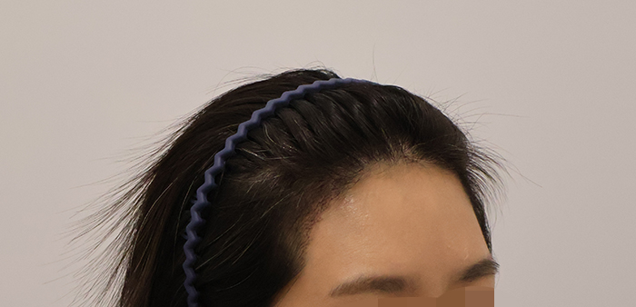 02.수술2주차.JPG