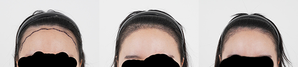 대구 모발이식 병원 모모, 3300모 절개 수술 후 한달이예요