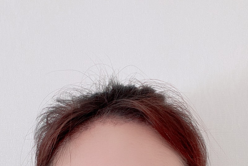 모앤라인 헤어라인 한달째 사진 올려봐요~~