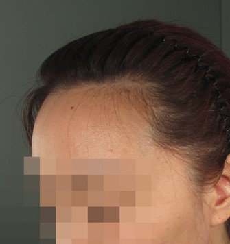수술전 정면에서 왼쪽.jpg