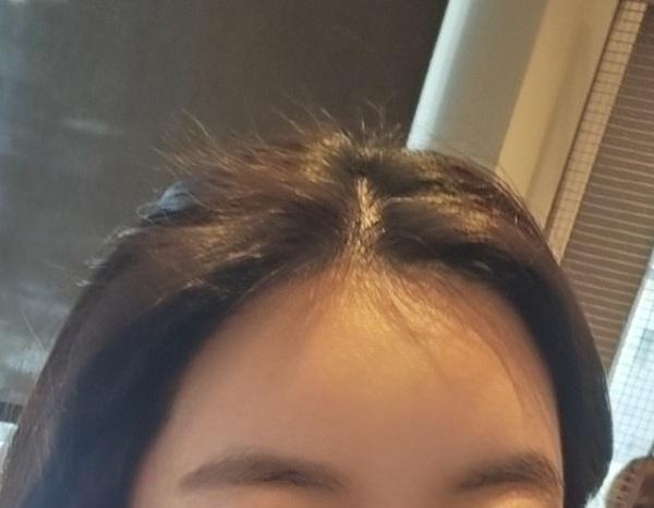 모나라피부과 여자m자 모발이식 8개월차 경과 2.jpg