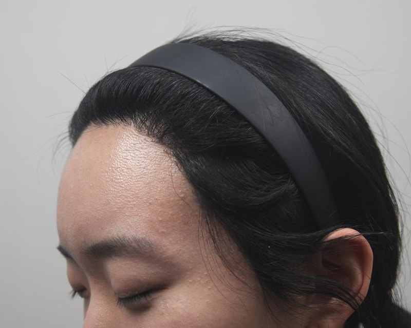 모나라 피부과 여성헤어라인 8개월 경과 1.jpg