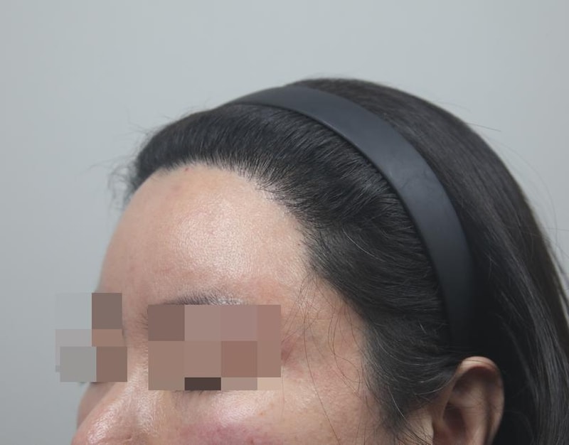 모나라피부과 여자m자 모발이식 8개월차 경과 4.jpg