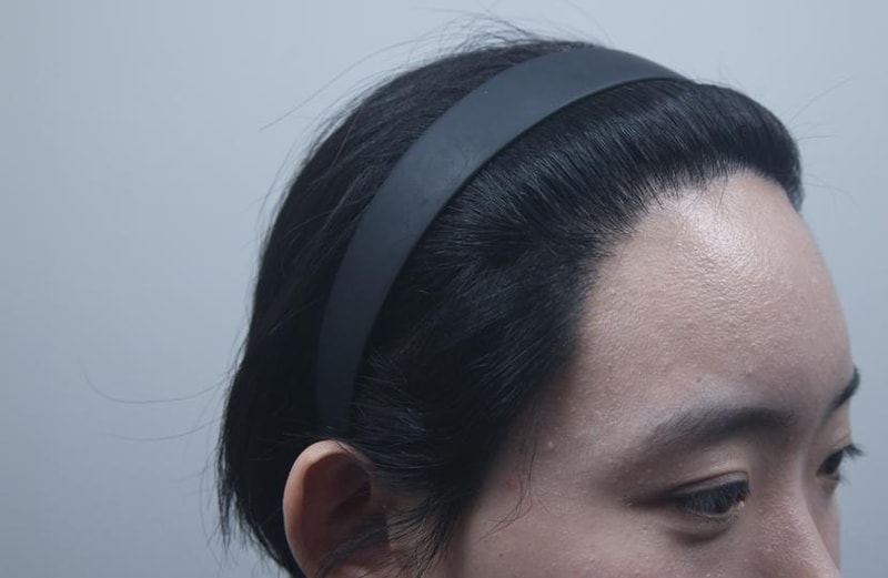 모나라 피부과 여성헤어라인 8개월 경과 2.jpg