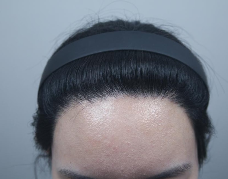 모나라 피부과 여성헤어라인 8개월 경과 3.jpg
