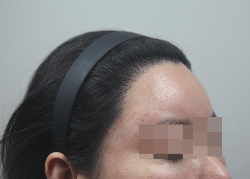 모나라피부과 여자m자 모발이식 8개월차 경과 5.jpg