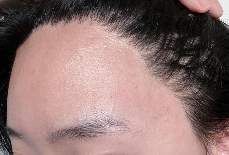 모나라 피부과 여성헤어라인 8개월 경과 4.jpg
