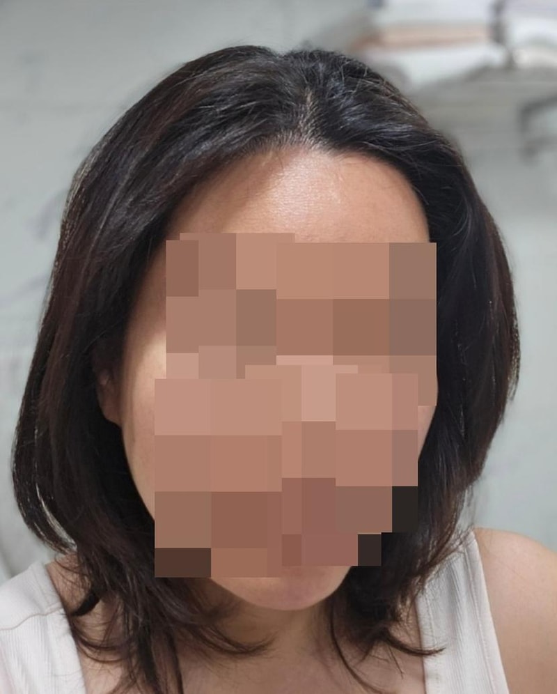 모나라피부과 여자m자 모발이식 8개월차 경과 3.jpg