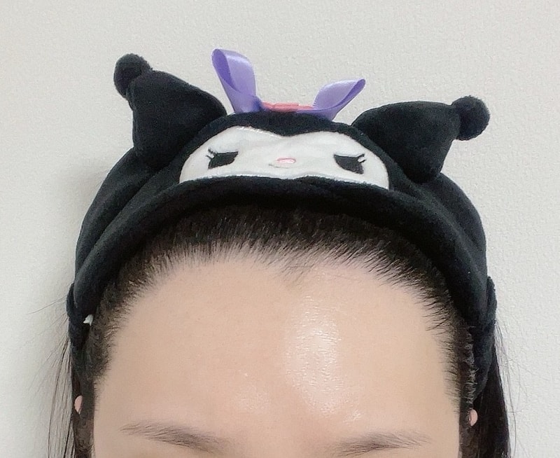 수술후 헤어라인.jpg