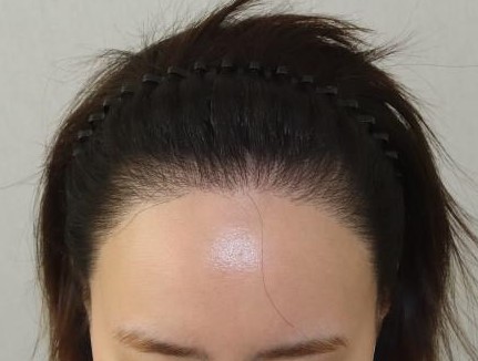 수술 전 2.JPG