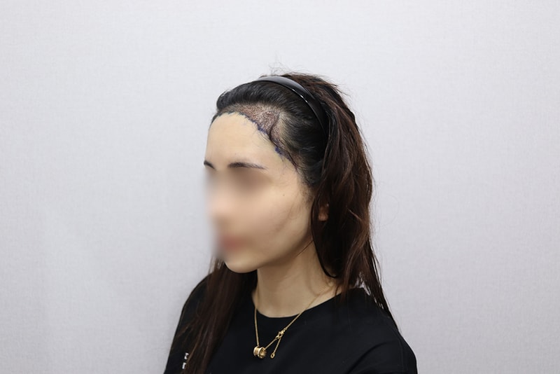 05.여자비절개2600모.JPG