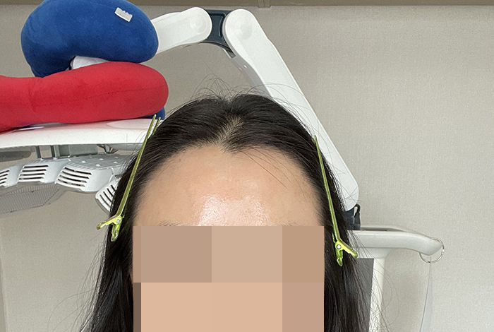 5.어제 병원경과보러 다녀왔어요 간김에 한번 못맞았던 주사도 맞고 옴.jpg