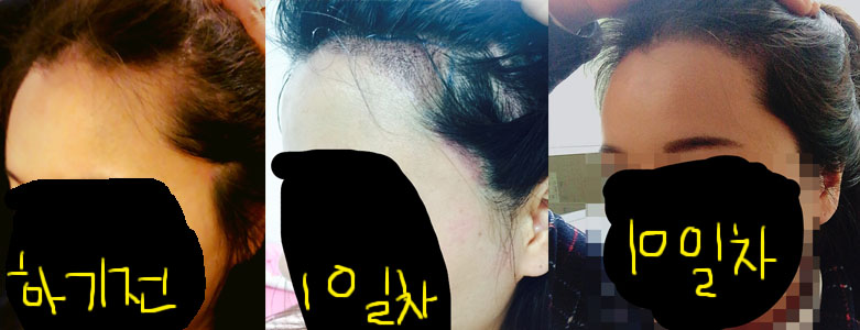 옆이마라인.jpg