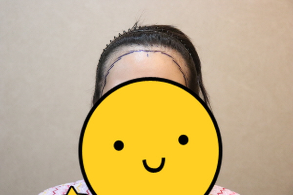 JP성형외과 1년 3개월 헤어라인 후기입니다