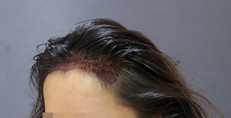 수술 후 왼쪽 측면.jpg