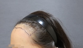 수술전 왼쪽 측면.jpg
