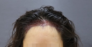 수술 후 정면_이거.jpg