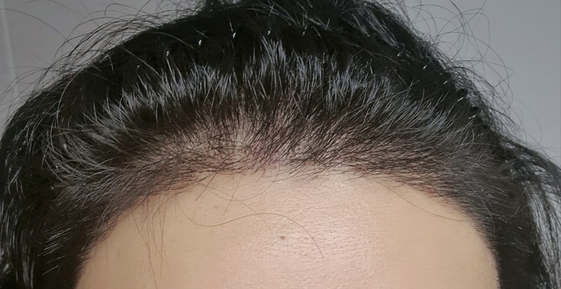 수술14일차_정면.jpg