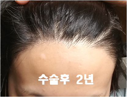 8. 수술후 2년.png