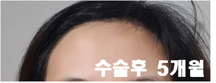 6. 수술후 5개월.png