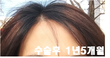 7. 수술후 1년5개월.png