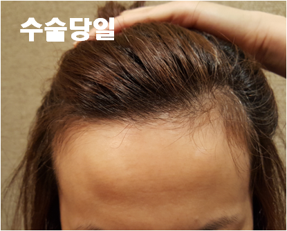 절개 3000모 2년4개월차 후기에요^^