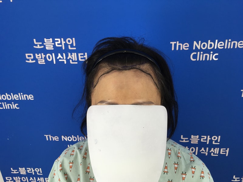 노블라인에서 헤어라인 했습니다.