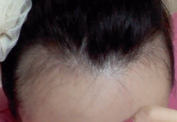 헤어라인교정 후기9.jpg