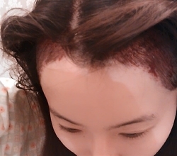 헤어라인교정 후기5.jpg