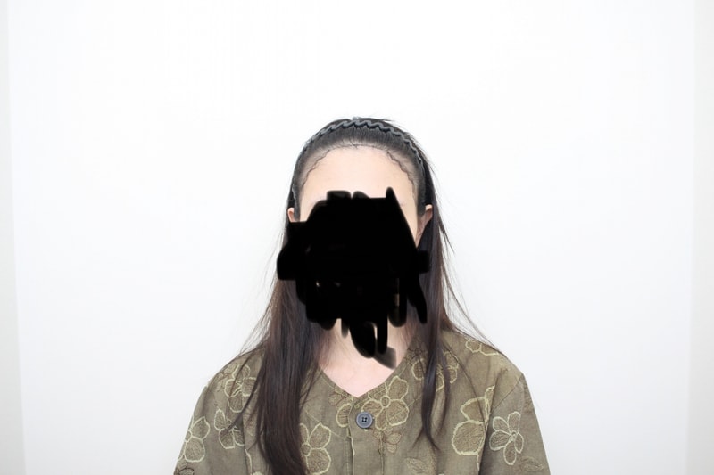 신사역 모프로의원●문건학대표원장님,여성헤어라인교정 8개월차
