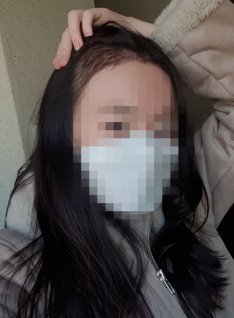 헤어라인 이식 2주 넘었어요!