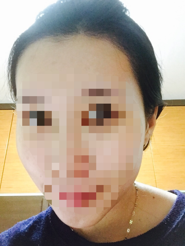 모제림 헤어라인 2500모 절개 8일차
