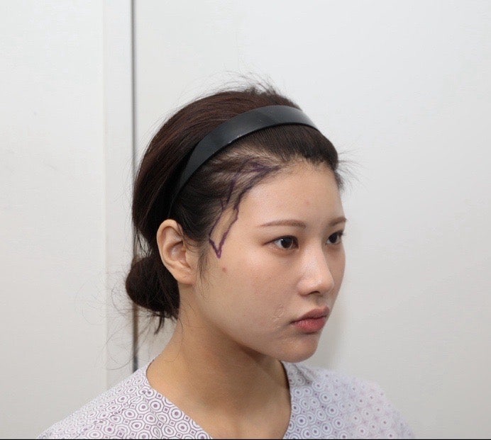 여자 비절개 800모낭 1년 2개월 이후 후기