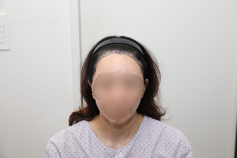 뉴헤어 절개 모발이식 1400모낭 1년경과