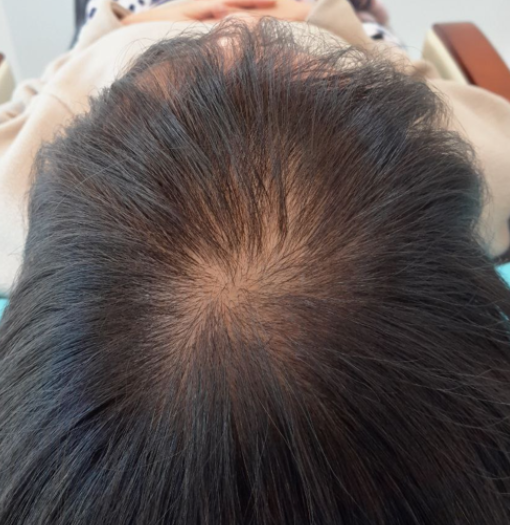 김미연 두피문신 전01.png