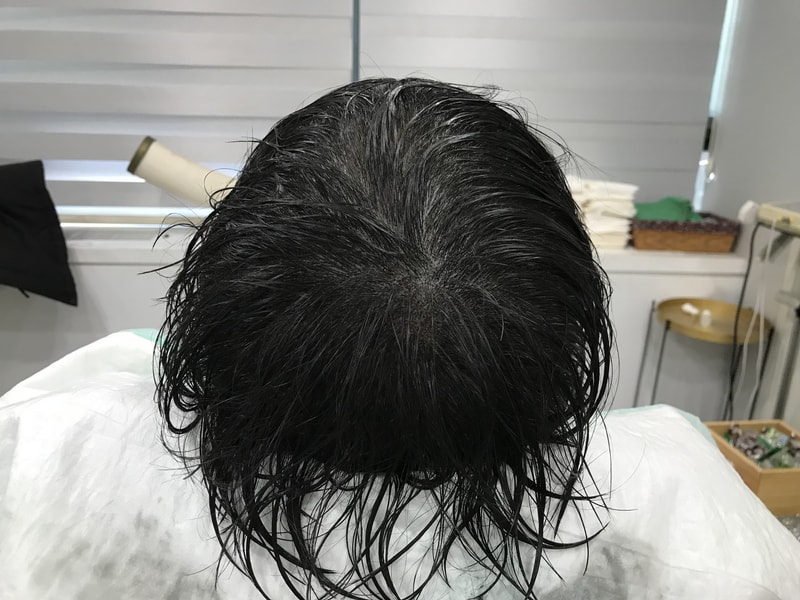 2차 시술후2.jpg